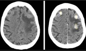 Descubren el proceso de la metástasis del cáncer en el cerebro