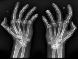 Artritis Reumatoide: Ataca por error a los tejidos sanos