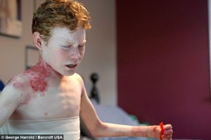 ¡Impresionante! Conoce a Jonathan, niño cuya piel se cae al toque (Fotos + Video)