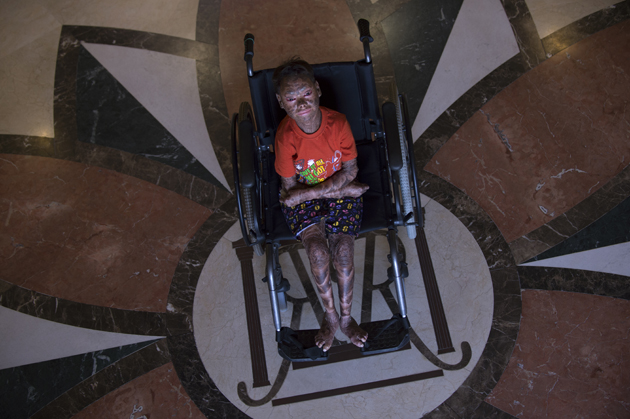 Shalini Yadav, 16, known as the "snake girl" poses in Marbella on September 15, 2017.  Shalini, who suffers recessive lamellar ichthyosis and sheds her skin every six weeks due to a rare condition, is to get life-improving treatment in southern Spain. / AFP PHOTO / JORGE GUERRERO