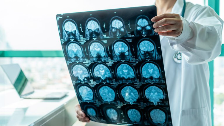Cansancio y “niebla cerebral”: Los síntomas persistentes de Covid-19 que más preocupan a los expertos