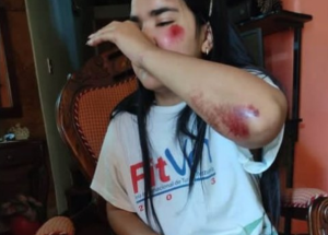 Practicaba ciclismo en Boconó cuando fue atacada sin razón por una pareja en moto (Fotos)