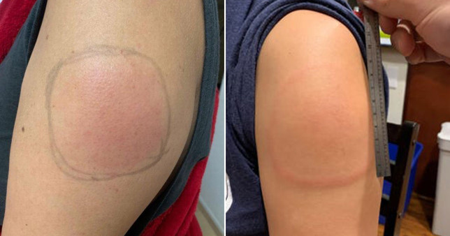 El raro efecto secundario de la vacuna contra el Covid-19 de Moderna que deja picazón e hinchazón en el brazo (FOTOS)