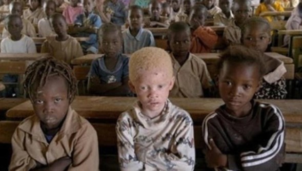 Ser albino: En África puede llevar a una horrible muerte, en Europa y América a ser una estrella de la moda
