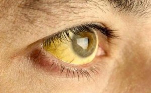 La fiebre amarilla: Cuáles son sus síntomas y cómo tratar la enfermedad