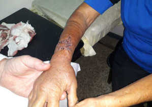 Pastor belga desatendido por sus dueños le destrozó la mano a una abuela en Caricuao