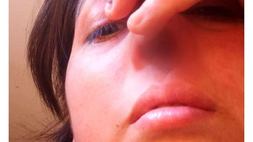 Mujer exige una reconstrucción nasal tras perder el cartílago por un hisopado mal hecho en Argentina