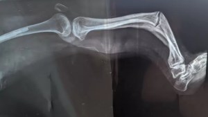 “Ya sufrí 100 fracturas”: cómo es vivir con la enfermedad de huesos de cristal