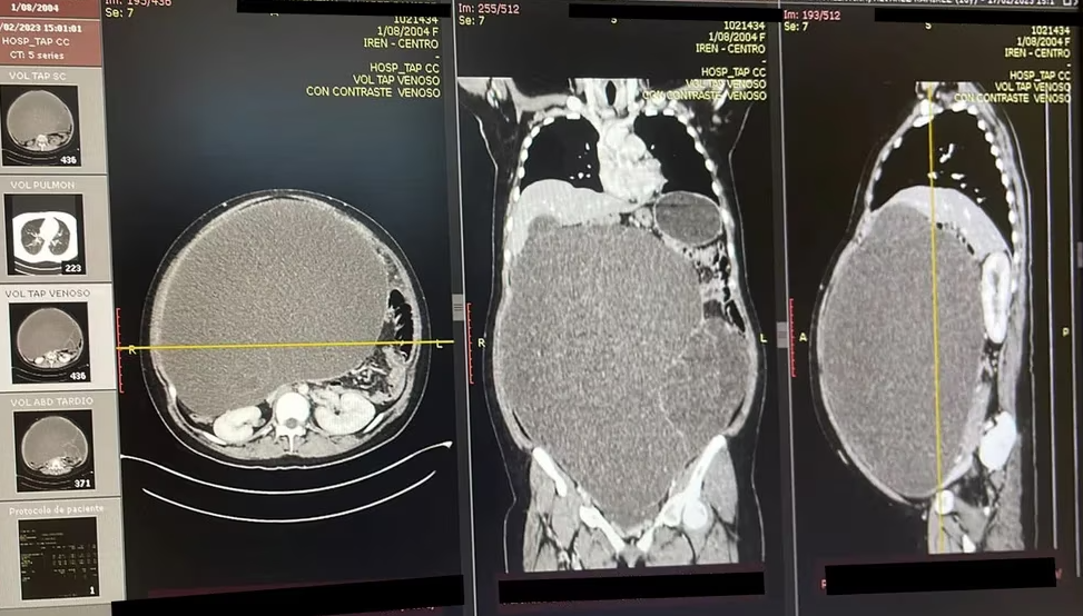 Tumor de 20 kilos fue extirpado del abdomen de una joven de 18 años