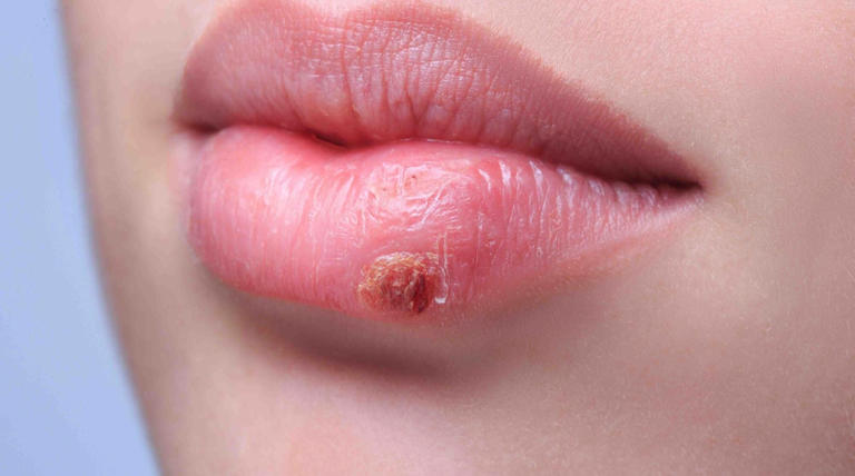 Estas son las causas más resaltantes por lo que se genera el herpes labial