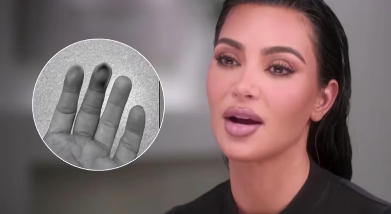 Kim Kardashian sufrió una fractura en su mano tras golpearse con una puerta: “Parecía que el hueso sobresalía”